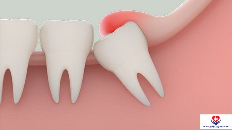Viêm nướu răng khôn là tình trạng nhiều người gặp phải