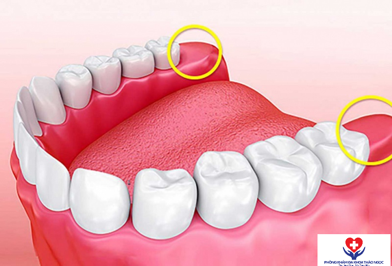 Hình ảnh mô phỏng vị trí răng khôn mọc gây viêm nướu